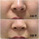 바로서면병원 (급식소포함) | 서면 실리프팅 후기 / 전 후 차이 대박! 팔자주름이 바로 펴져버림!!!