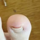 누빌샵1 | 내성발톱교정 누빌샵1 내향성 발톱 교정기 사용 후기