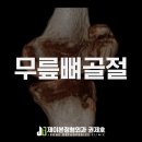 제이본정형외과의원 | 무릎뼈골절 patella 1년 후기 / 제이본정형외과 권제호