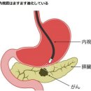 무서운 췌장암 빨리 발견하려면 어떤 검사가 좋은가? 이미지