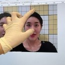 성수한의원 두나안면비대칭 4회차 전 후 후기 땅콩형얼굴 추천