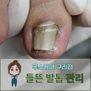경춘로227번길 | 들뜨고 아픈 발톱 복원 관리 1~3차 후기 푸스케어 구리점