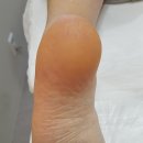 나도손톱 레푸스 개봉점 이미지