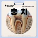 명일동치과치료 충치치료 치아가 욱씬거리고 너무아파요