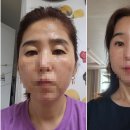 포픽스 이마거상 케이스 신사역 오늘성형외과
