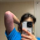 [내돈내산] 부산 팔뚝, 러브핸들 무한람스 후기(상담~2주차, 고통, 비용, 일상생활, 음주)