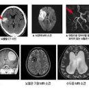 귓볼주름, 귀주름, 치매 뇌졸중 위험! 이미지