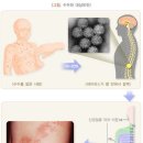 대상포진 분류표[별표-질병관련25] 이미지