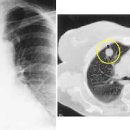 고립성 폐결절 및 (흉부 전선량 폐 CT) 이미지
