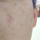 피에이치디피부과의원 네이버블로그