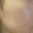 제일장의용품 | 진주피부관리 여드름흉터 차크란에스테틱 내돈내산 피부변화 솔직후기