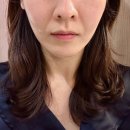 전후관리 확실한 곳에서 인생 첫 써마지 600샷 솔직&amp;자세 후기!! (10곳 비교 후 선택한 곳..)