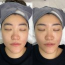 면목동-015 | 리프팅 사가정리프팅 사가정피부 중랑구피부 면목동피부관리 상봉피부관리 중랑구에스테틱 사가정에스테틱