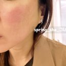 세계로치과병원 | 부산 해운대 센텀시티 모공 포텐자 후기 효과 솔직 기록 (통증, 붉은기, 변화 과정)