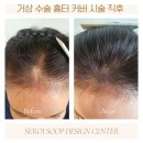 오래된 고민 끝! 파주 탄현면 흉터 제거로 새 피부 되찾은 감동 후기 (일산 백병원 근처)