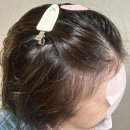 영헤어라인 이미지