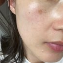 얼라이브피부과의원 | [천안아산] 얼라이브피부과의원 흑자제거 후기