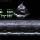 Mild Apical hypertrophy 이미지