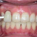 미백세탁 | 당산동 치과 원데이 화이트닝, 미백 치약보다 효능 확실한 이유는?!