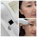 고랑포길 | 홈케어디바이스 린커브 한 달 관리 후기! 뷰티디바이스로 턱선관리 루틴 만들기