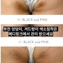 메디웨어 | 부천 엉덩이, 겨드랑이 색소침착은 메디핑크에서 관리 받으세요