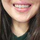 지에스25 솔라고크라운점 | 교정인 앞니 변색 치료 방법 비교: 크라운 vs 실활치미백 (경험 후기)