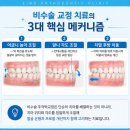미소준치과의원 | 강남치아교정 개방교합 원인부터 잘하는곳 치료 후기와 가격