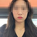 톡스앤필의원불당점 | 웨딩준비 톡스앤필 국산 턱보톡스 내돈내산 후기