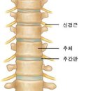 추간판 탈출증[lumbar herniated intervertebral disc] 이미지