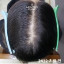 멘토의원 | 30대여자정수리탈모 실제 치료 사례 후기 멘토의원