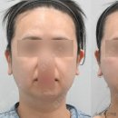 리프팅 시술을 많이 받았는데도 왜 그대로일까요?