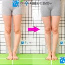 변정형외과의원 | 오다리교정후기 오다리후기사진 모두 이정도로 좋아지면 좋겠습니다
