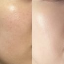 노원사우나 | 노원피부과 스킨부스터 후기 (리쥬란, 쥬베룩, 에버클 차이)