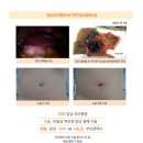 담낭선근종증수술후기. 수술은 11분만에 끝났고 배꼽에 지방종, 담낭주변에 염증 때문에 생긴 장기 유착까지 다 떼어 주셨습니다. 이미지