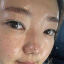 [평택] 홍조 예민피부 유산균 테라피 관리 후기