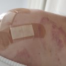 류마티스 어깨 통증: 어깨 힘줄 염증 후기😭 어깨 힘줄 염증 주사 💉 프롤로주사 후기!