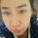 모아의원 | 수원인계 세모아의원 팔자필러후기