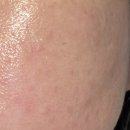 제이앤비 | 스킨보톡스 내돈내산 후기 ㅣ 닥터제이앤비의원