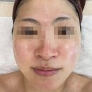 연메디 | 분당 물광관리 제대로 받고 온 후기, 미금 피부관리 채비연 플라즈마 물방울 광채케어