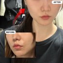수치킨 | 피부 탄력 세포부터 채우는 리투오 스킨부스터 후기 (+루스킨엑스 피부진단)