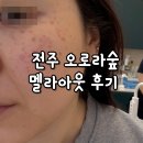 주정차30 | 전주피부관리 오로라숲 기미 주근깨 제거 후기