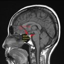 Pituitary adenoma 이미지