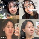 천안 신부동 피부과 텐써마 300샷 솔직후기 통증 효과 전후 비교