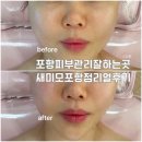 새미모 | 포항피부관리 잘하는곳 새미모 포항점 써마젯 고주파 베이직 리얼후기