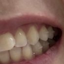 썬프라자 | 30대가 되어 교정시작하다.. 토끼이빨앞니 비발치투명교정 1주차 후기 서울 썬프라자치과 내돈내산