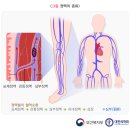 심부정맥혈전증 이미지