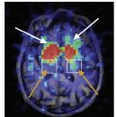 Re: 파킨슨 호전 케이스 논문(centering prayer 매일 30분, 2년) 2016년... 이미지