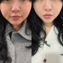 내돈내산 압구정역 피부과 역대급 롱타임 인모드 얼굴전체 후기 효과 (여기서 효과 없으면 다른데서도...