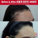 한승밸런스 | 여자모발이식후기 밸런스 있는 얼굴형과 매끈한 라인을 위해