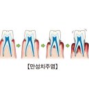 만성 이미지